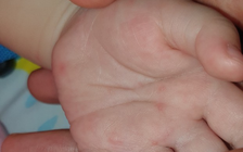 TP.HCM tìm nguồn cung ứng thuốc điều trị bệnh tay chân miệng