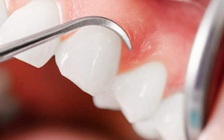 Ngày mới với tin tức sức khỏe: Thuốc mới giúp người trưởng thành có thể mọc lại răng