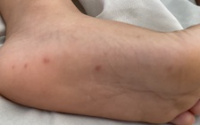 TP.HCM: Số ca mắc tay chân miệng tăng 2 lần so với trung bình 4 tuần trước