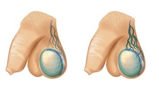 Giãn tĩnh mạch tinh gây vô sinh ở nam giới