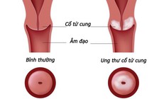 Đề xuất đưa sàng lọc ung thư vào danh mục được Quỹ BHYT chi trả