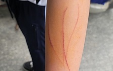 Nam sinh lớp 7 bị bạn hành hung gây thương tích