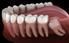 Dấu hiệu cảnh báo răng khôn đến lúc cần nhổ