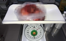 Đồng Nai: Khối u nặng 2,5 kg trong ngực người đàn ông