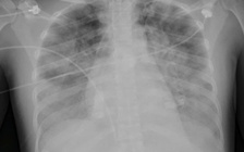  2 phụ nữ ở TP.HCM nhiễm 'vi khuẩn ăn thịt người'