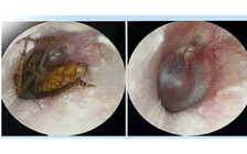 Suýt bị điếc do con gián chui vào tai khi đang ngủ