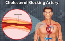 Top thực phẩm giúp giảm cholesterol cao