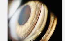 Làm thẻ căn cước buộc thu thập mống mắt: Có khi nào mống mắt bị thay đổi?