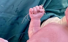 2 em bé chào đời cùng... vòng tránh thai của mẹ