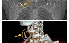 Khám sức khỏe, phát hiện chiếc đinh rỉ trong cổ bệnh nhân