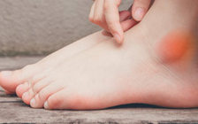 Sưng phù mắt cá chân: 4 căn bệnh nguy hiểm có thể đang mắc
