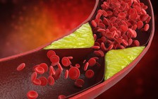 6 thói quen buổi sáng giúp giảm nhanh mức cholesterol cao