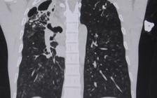 Người đàn ông ho ra cả chén máu vì vỡ mạch máu phế quản