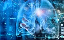 Ứng dụng AI chẩn đoán ung thư phổi