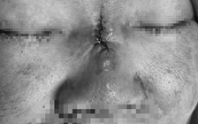 Tốn 65 triệu đồng, mũi hoại tử vì tin thầy phong thủy đổi vận