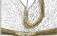 Bệnh tổ lông vùng cùng cụt