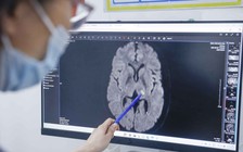 Nguyên nhân tăng nguy cơ đột quỵ khi thời tiết chuyển lạnh