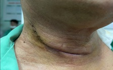 Khàn tiếng kéo dài, đi khám phát hiện mắc cùng lúc 2 loại ung thư