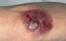 Nhiều ca bệnh ngộ độc thuốc do sử dụng sai liều