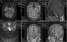 Khát nước dữ dội, bệnh gì?