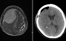 Đau đầu, yếu nửa người, khám bệnh phát hiện khối u màng não nặng 600 gram