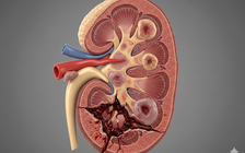 Huyết áp cao hay lượng đường cao gây hại thận nhiều hơn?