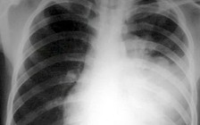 Cảnh báo về vi khuẩn trong hơi thở dễ làm lây lan bệnh hô hấp