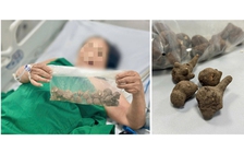 Nguy kịch do uống nước củ ấu tầu trị đau khớp