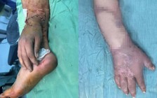 Bệnh viện đa khoa Bình Dương nối lại bàn tay đứt lìa cho thai phụ