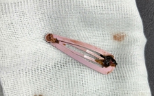 Nuốt kẹp tóc dài 7 cm trong lúc ngủ trưa, bé gái 6 tuổi phải nhập viện