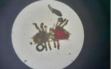 Người đàn ông 56 tuổi bị ngứa dữ dội do rận ký sinh