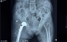 Thay khớp háng thành công cho cụ bà 100 tuổi