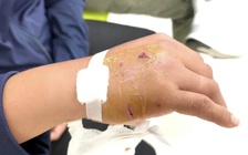 Bác sĩ hướng dẫn xử trí khi bị chó cắn