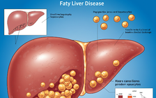 Ngày mới với tin tức sức khỏe: Bệnh gan nhiễm mỡ nguy hiểm thế nào?