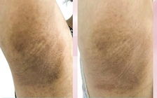 Bệnh nhân nữ khổ sở vì đổ nhiều mồ hôi