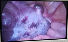 Bé 9 tuổi đau bụng, nôn ói nhập viện phát hiện u buồng trứng xoắn hiếm gặp