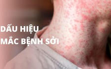 Sởi tấn công, gây tử vong ở người lớn