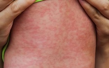 Cảnh báo nhóm nguy cơ cao bị biến chứng nặng do sởi