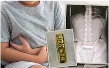 Cậu bé 11 tuổi nuốt thỏi vàng gần 3 lượng