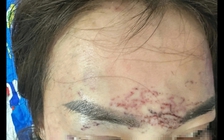 Cà Mau: Một phụ nữ tố bị bắt, đánh đập, xăm mặt, tạt axit vì ghen