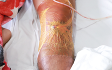 Đau nhức gối, nhập viện phát hiện bị 'vi khuẩn ăn thịt người' tấn công