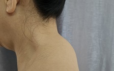 Thoái hóa, gai cột sống, khi nào cần phẫu thuật?