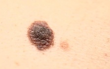 Suýt mất bàn chân do bị bỏ qua xét nghiệm ung thư 'nốt  ruồi' đen