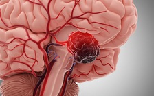 Nghiên cứu: Thuốc mới 'phá cục máu đông' khẩn cấp, chữa đột quỵ