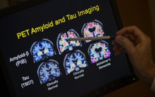Xét nghiệm máu đầu tiên cho bệnh Alzheimer được Mỹ phê duyệt