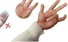 Hội chứng 'ngón tay lò xo' là gì?