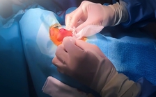 Tự nặn mụn vùng chữ T: Bác sĩ cảnh báo biến chứng nguy hiểm