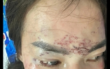 Khởi tố vụ án người phụ nữ bị bắt giữ, đánh đập, tạt axit vì ghen