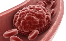 Kỹ thuật đột phá có thể cứu bệnh nhân đột quỵ hiệu quả đến 90%