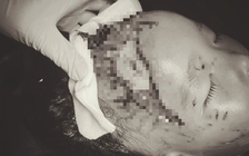 Bé trai 2 tuổi bị chó cắn lộ xương sọ khi sang nhà người thân chơi